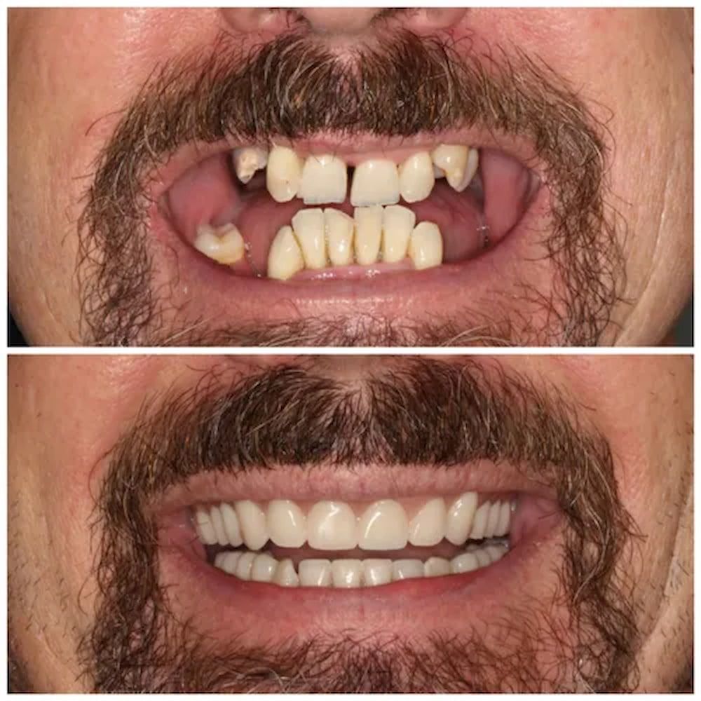 Before and After Comparison of a Man's Teeth — Smiles on Hudson In Hamilton, NSW
