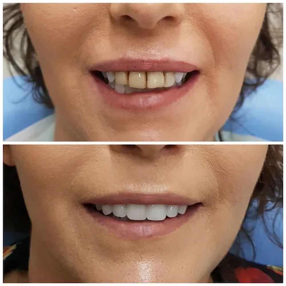 Before and After Comparison of a Woman's Smile — Smiles on Hudson In Hamilton, NSW
