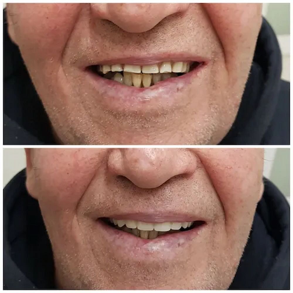 Side-by-side Comparison of a Man's Smile, Before and After Teeth Whitening — Smiles on Hudson In Hamilton, NSW

