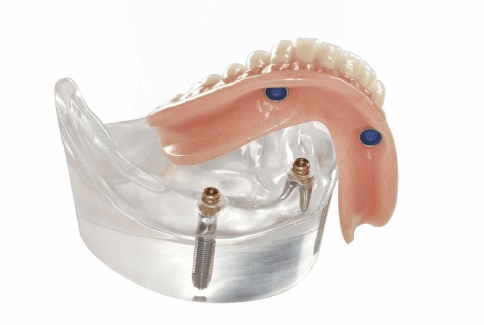 Model of a Lower Jaw With Dental Implants — Smiles on Hudson in Hamilton, NSW