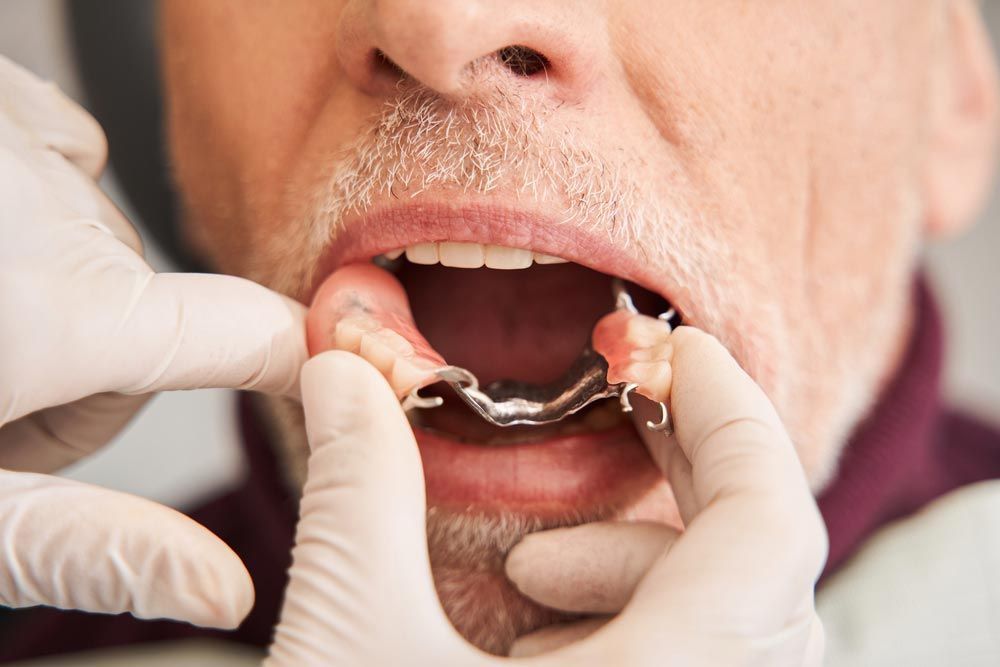 Dentist Placing Partial Dentures in Older Man's Mouth — Smiles on Hudson In Hamilton, NSW

