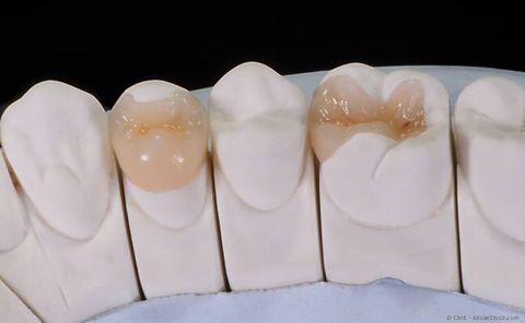 Inlay für den Zahn: Das sollten Sie über die Zahnfüllung wissen