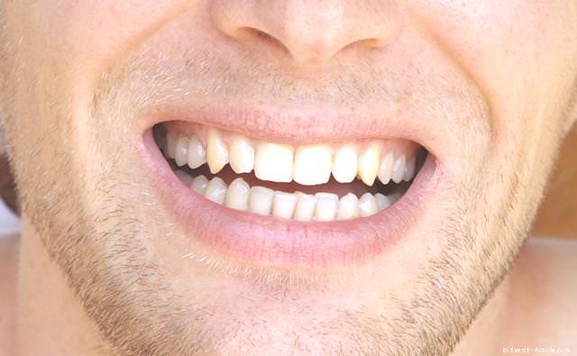Von anderen nicht zu sehen: Zahnfarbene Schneidezahnfüllung aus Komposit