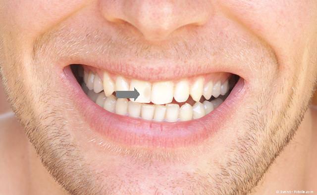Einfache Kunststofffüllung, die als dunkler Fleck im Zahn zu sehen ist