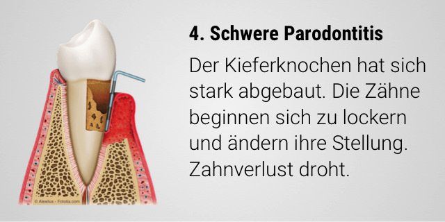 Parodontitis: Stark abgebauter Kieferknochen und Zahnlockerung