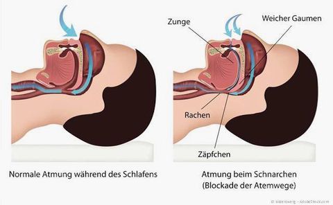 Ursache für das Schnarchen: Zunge und weicher Gaumen blockieren die Atemwege