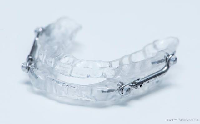 Schnarcherschienen: Sofortige zahnärztliche Hilfe gegen Schnarchen und Schlafapnoe