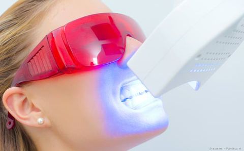 Power-Bleaching: Schnelle Zahnaufhellung in der Praxis mit einer speziellen Bleaching-Lampe