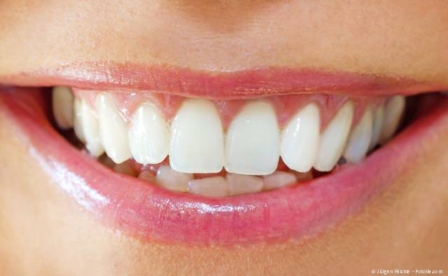 Bleaching: Weiße Zähne nach der Zahnaufhellung