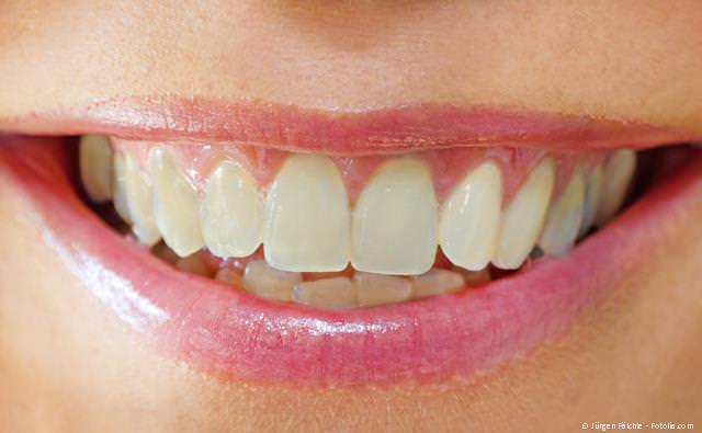 Bleaching: Dunkle Zähne vorher