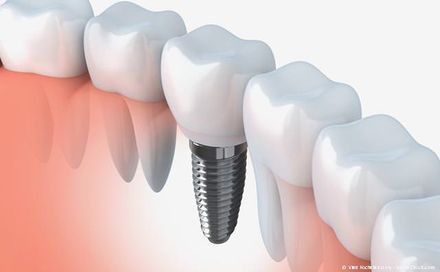 Implantate ersetzen fehlende Zähne
