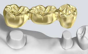 Implantate ersparen das Abschleifen eigener Zähne für Zahnbrücken