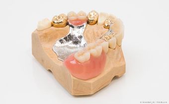 Mit Implantaten können festsitzende Zähne statt herausnehmbarer Teilprothesen eingesetzt werden