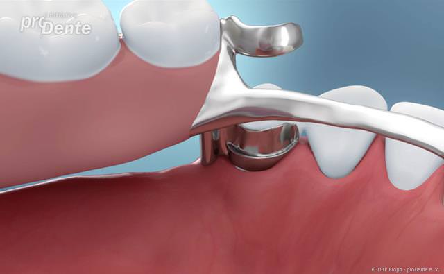 Herausnehmbarer Zahnersatz Geschiebeprothese