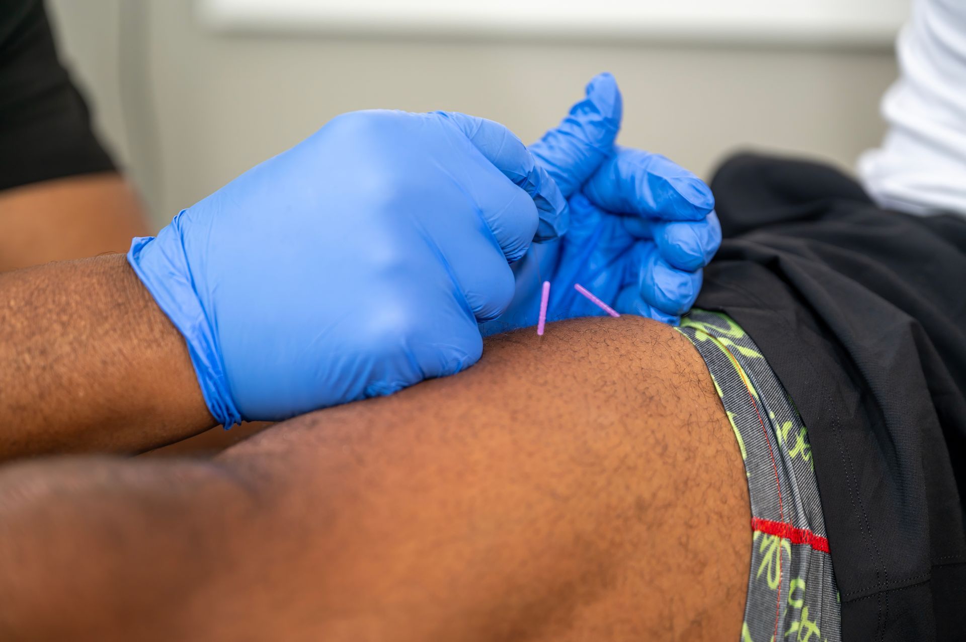 Dry Needling Treatment Clinic near me