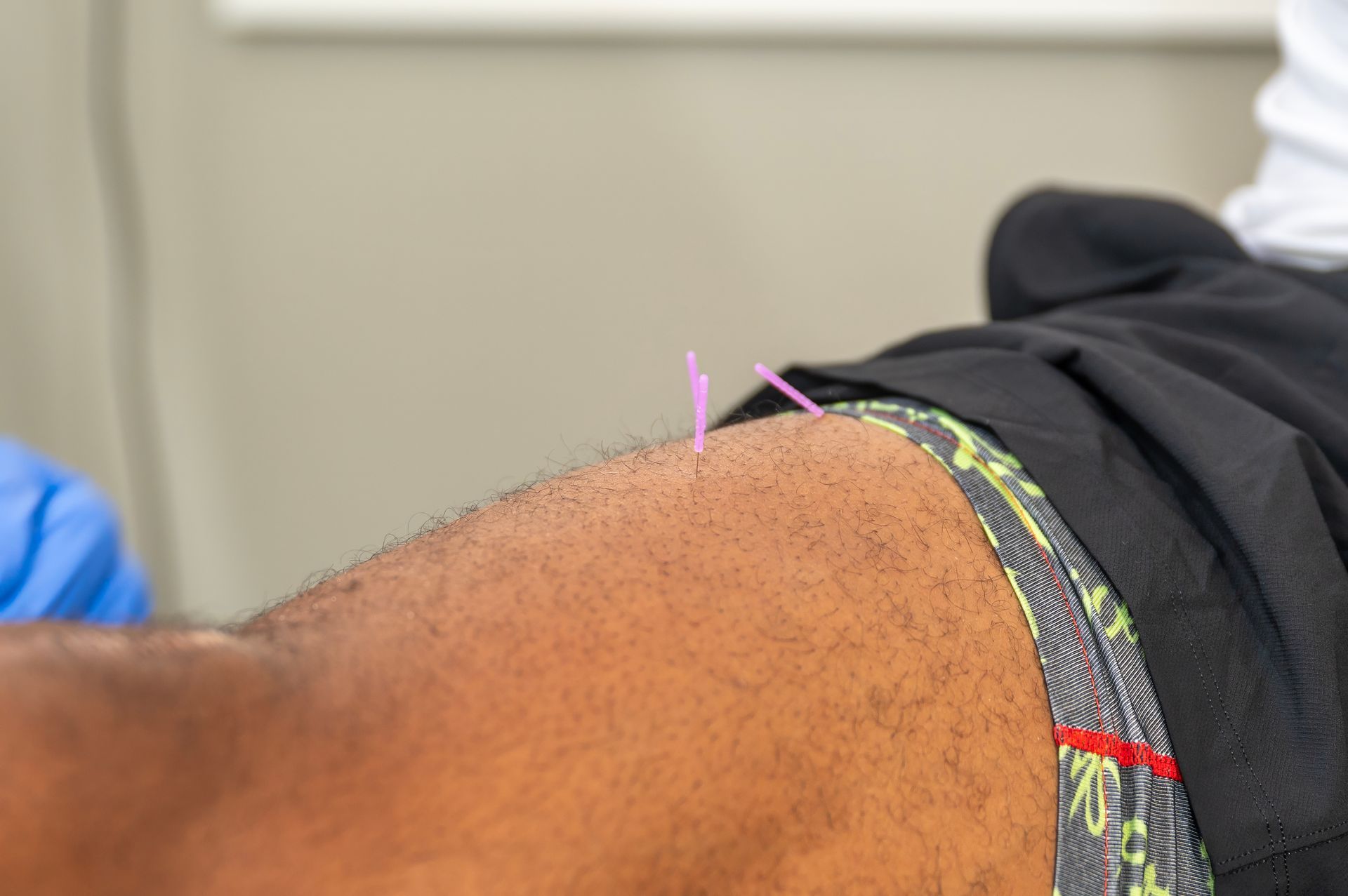 Dry Needling Pain Relief