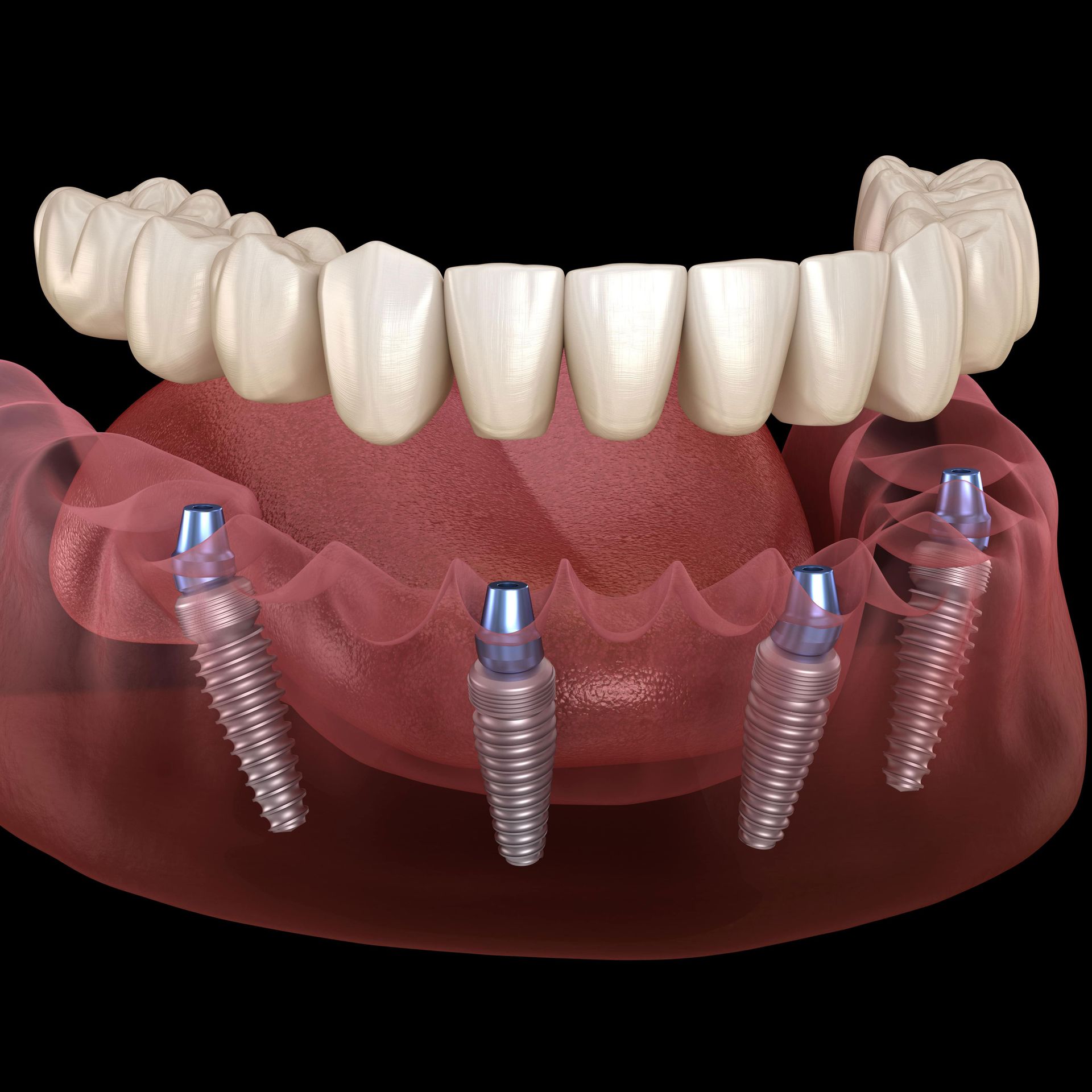 A computer generated image of a full denture with dental implants.