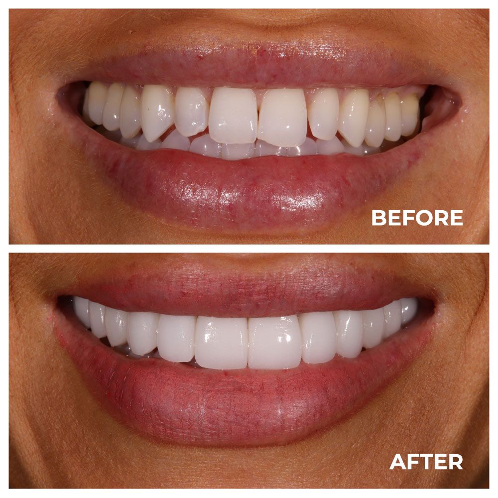 A close up of a person 's teeth with a pair of tweezers