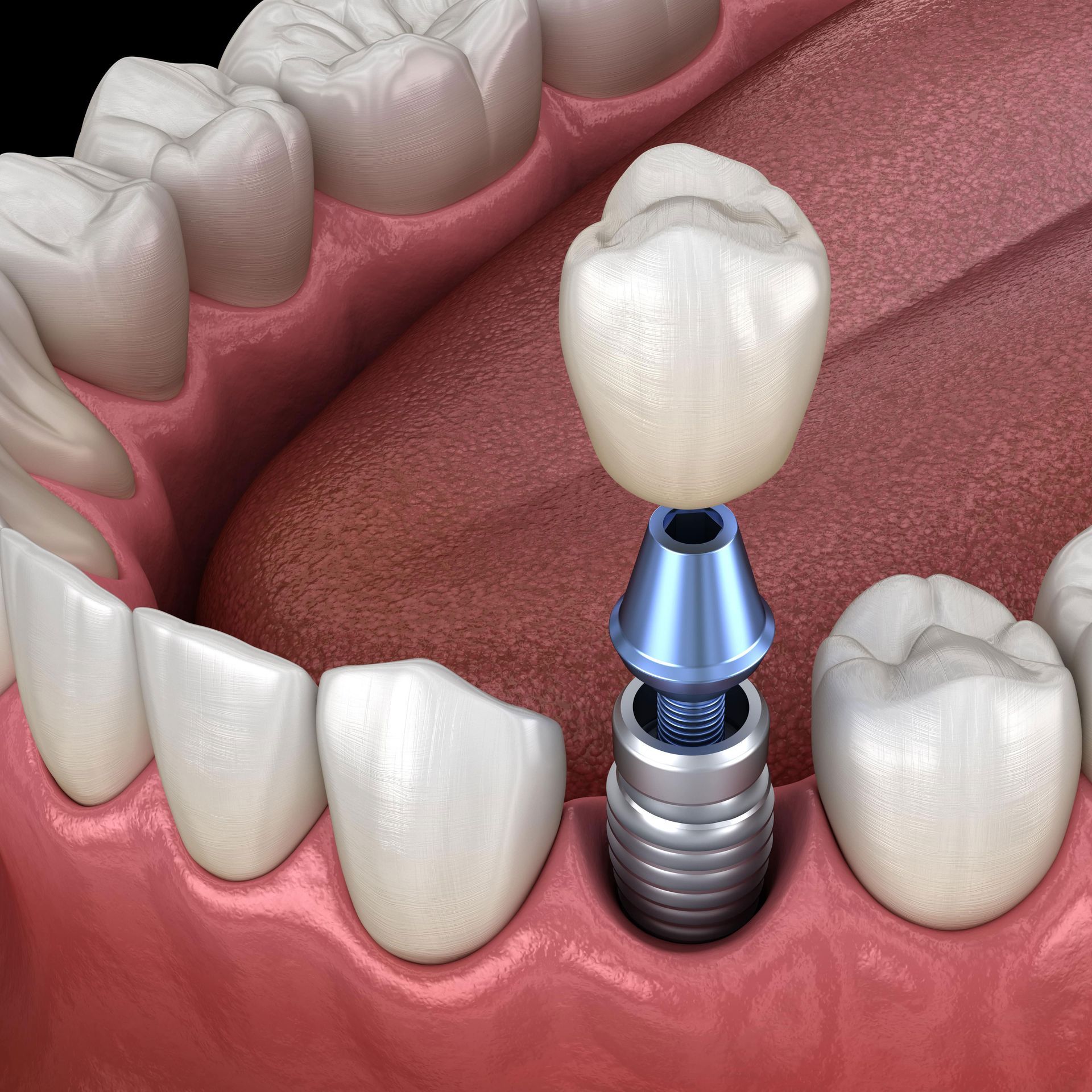 A computer generated image of a dental implant in a person's mouth