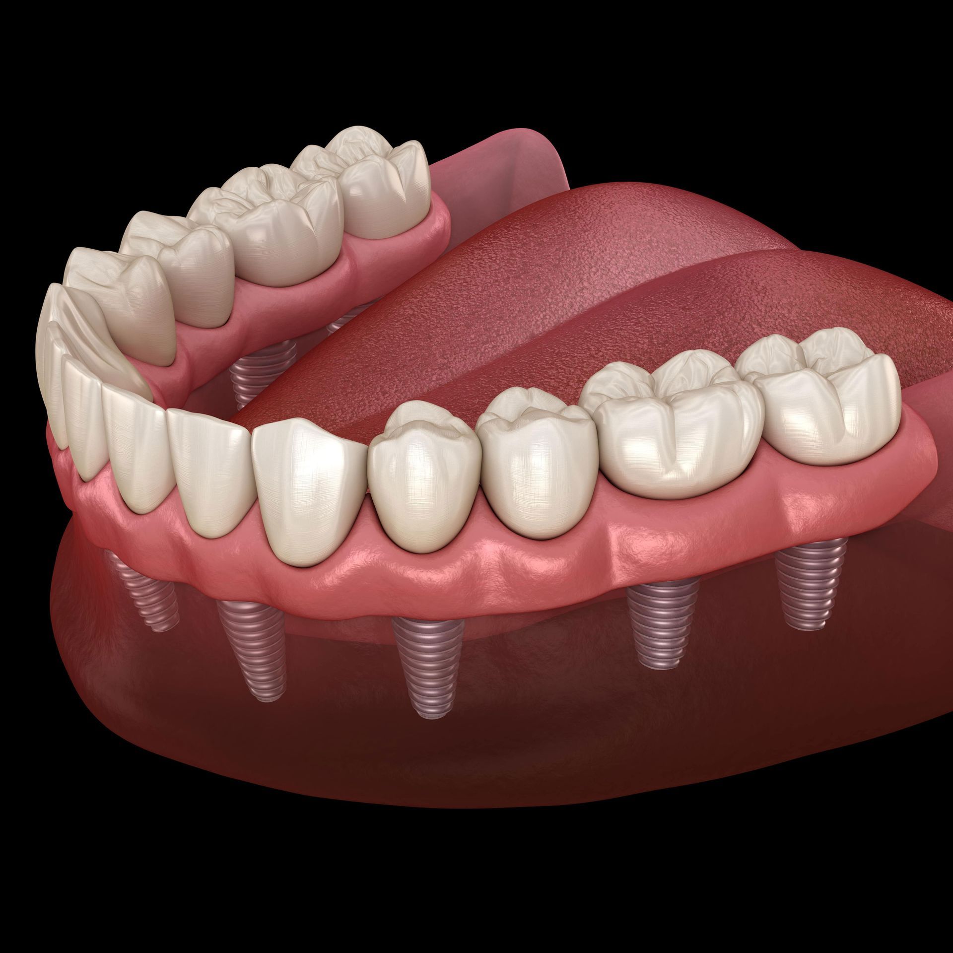 A computer generated image of a full denture with dental implants.