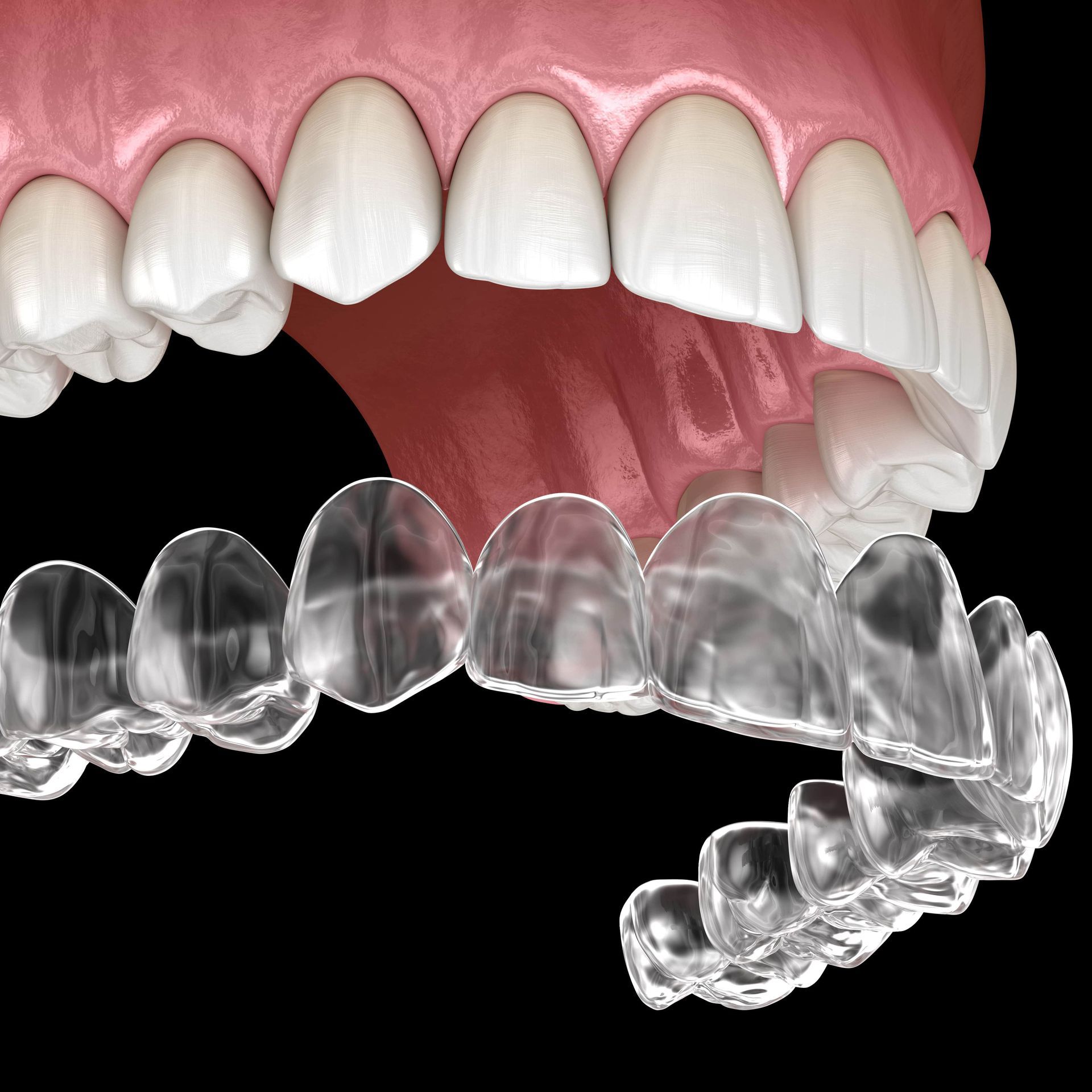 A close up of a person's teeth with clear braces