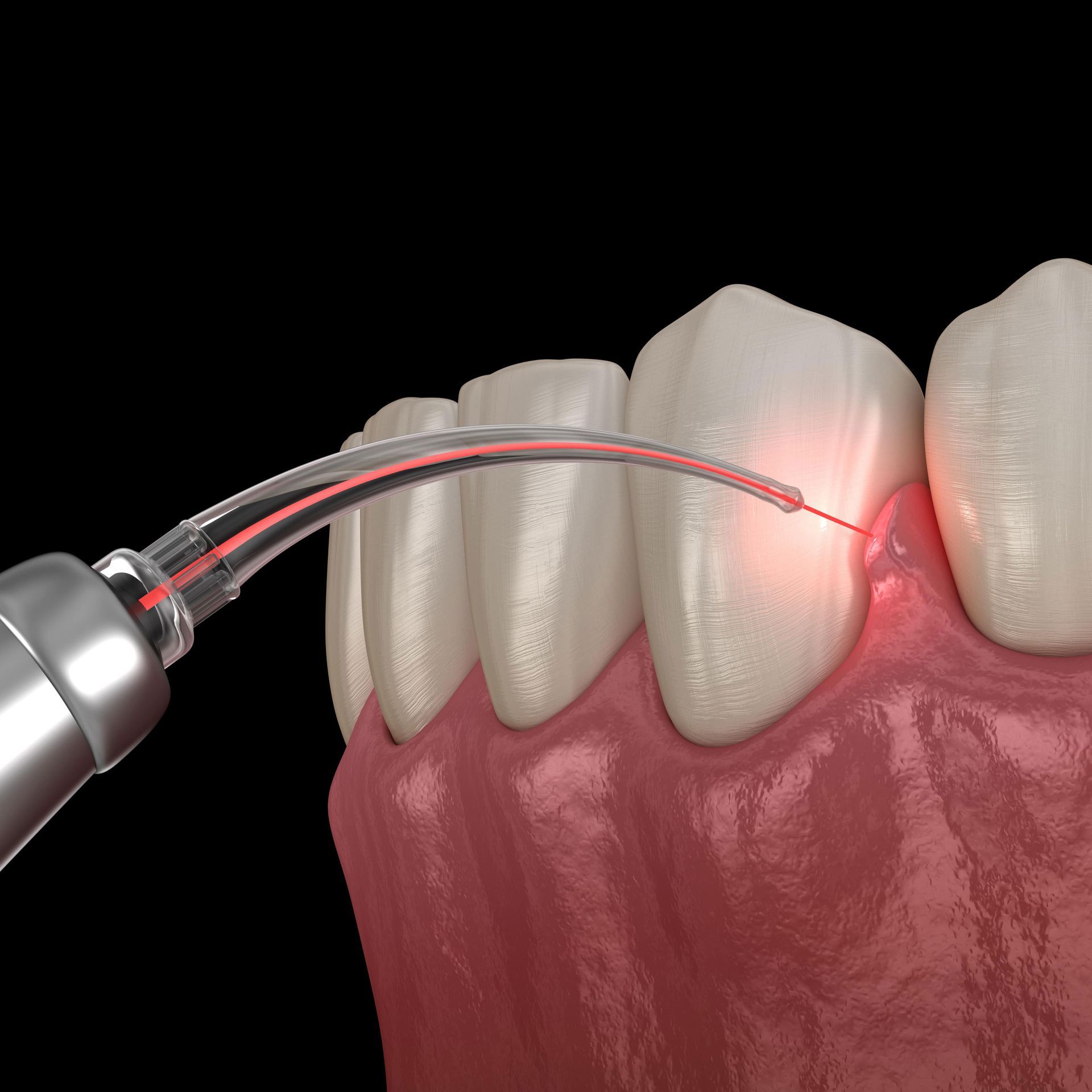 A close up of a person's teeth being treated with a laser