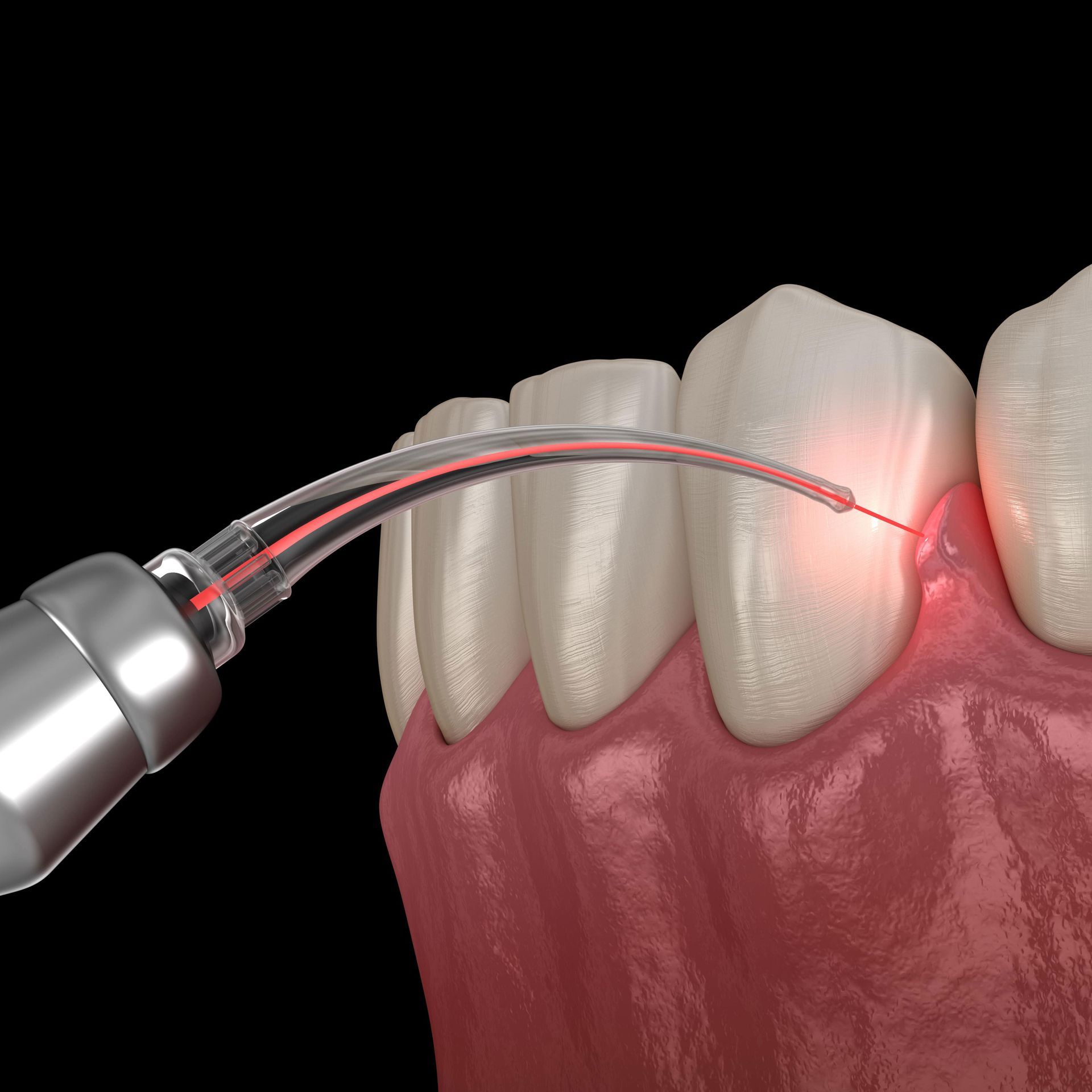 A close up of a tooth being treated with a laser