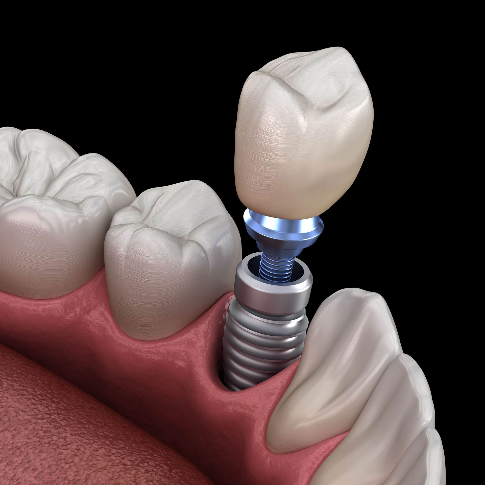 A close up of a tooth with a dental implant in it