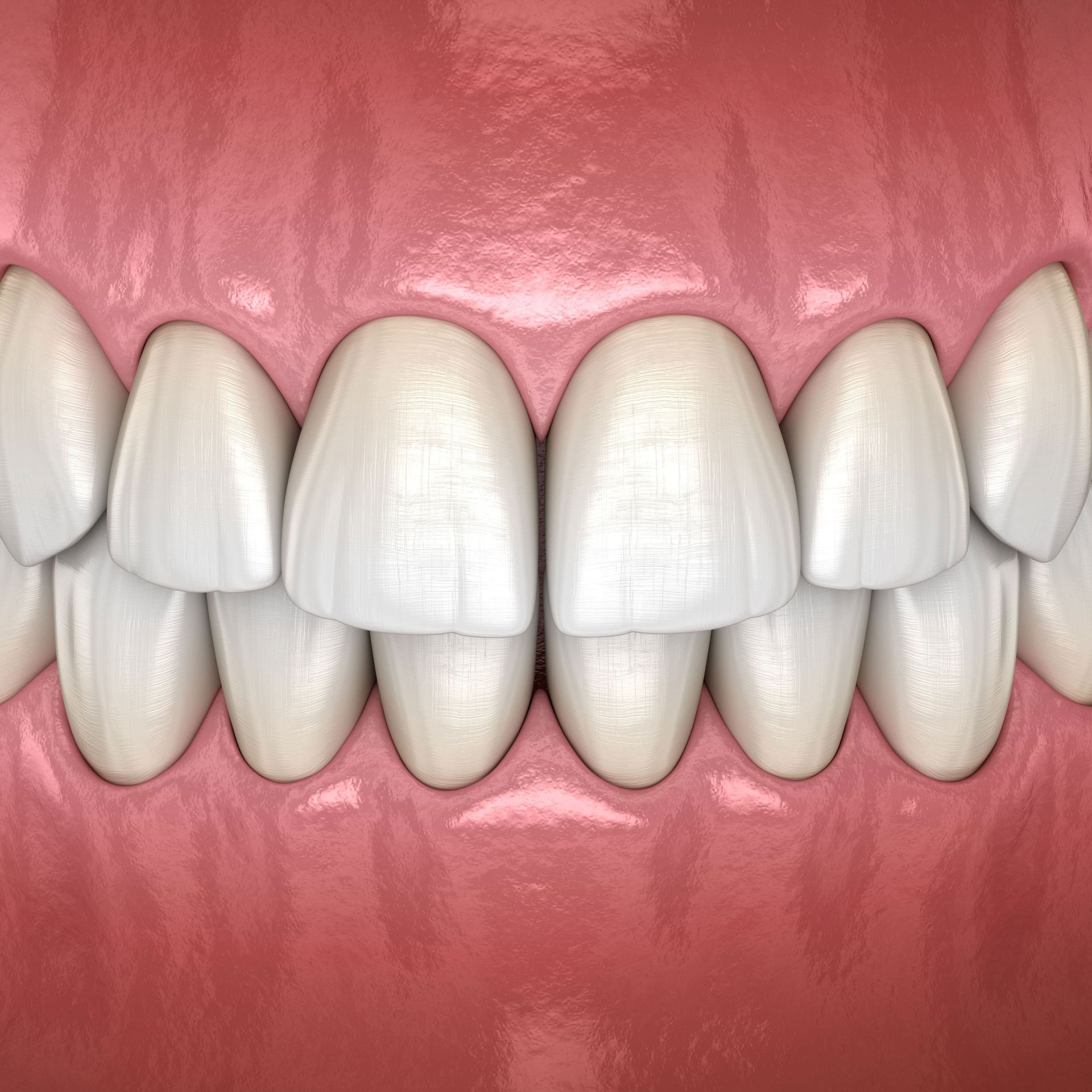 A close up of a person 's teeth with a pink gums.