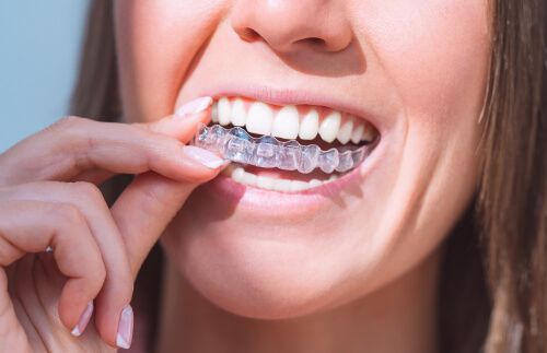 Can Invisalign Cause Gum Recession? : Sindledecker Dentistry