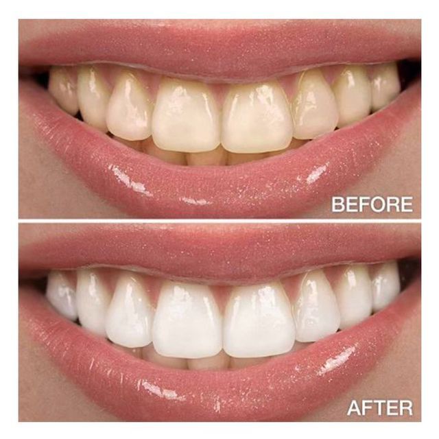 Cosmetic Dentistry Results