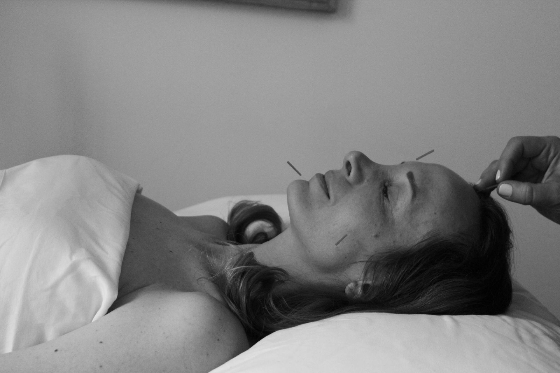 Woman lying on a bed while another person applies acupuncture to her forehead