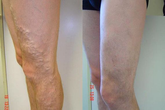 Legs before and after varicose vein treatment; left leg shows prominent veins, right leg appears smoother.