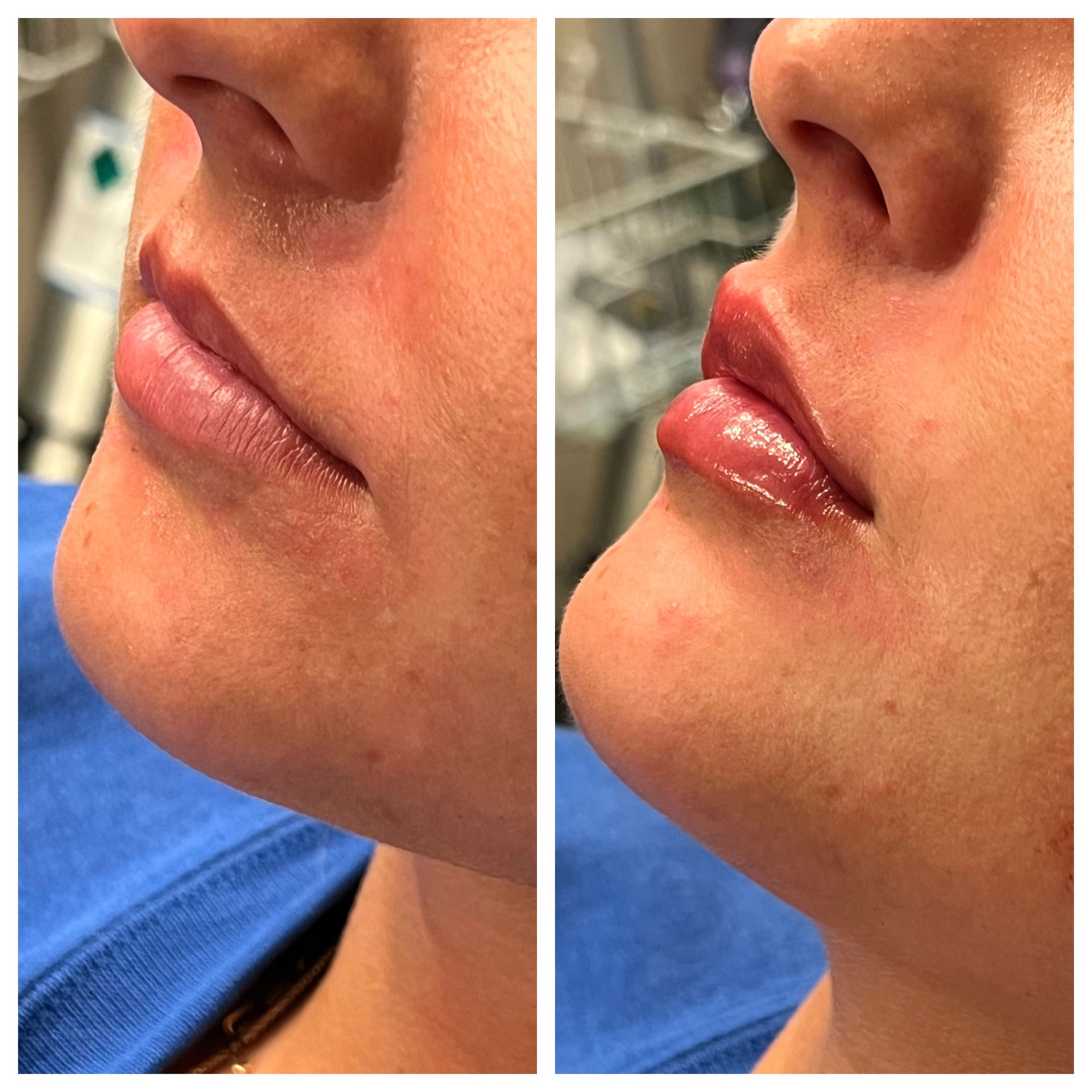 A before and after photo of a woman 's lips.