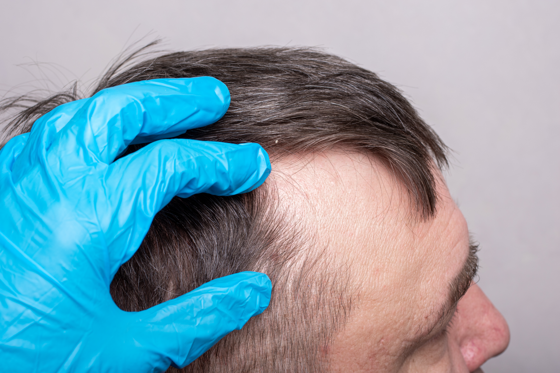 A man is getting his hair examined by a doctor wearing blue gloves.