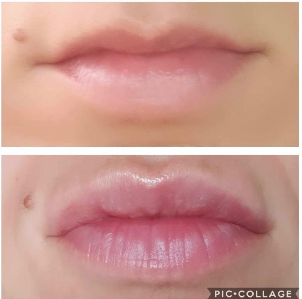 a before and after picture of a woman 's lips .