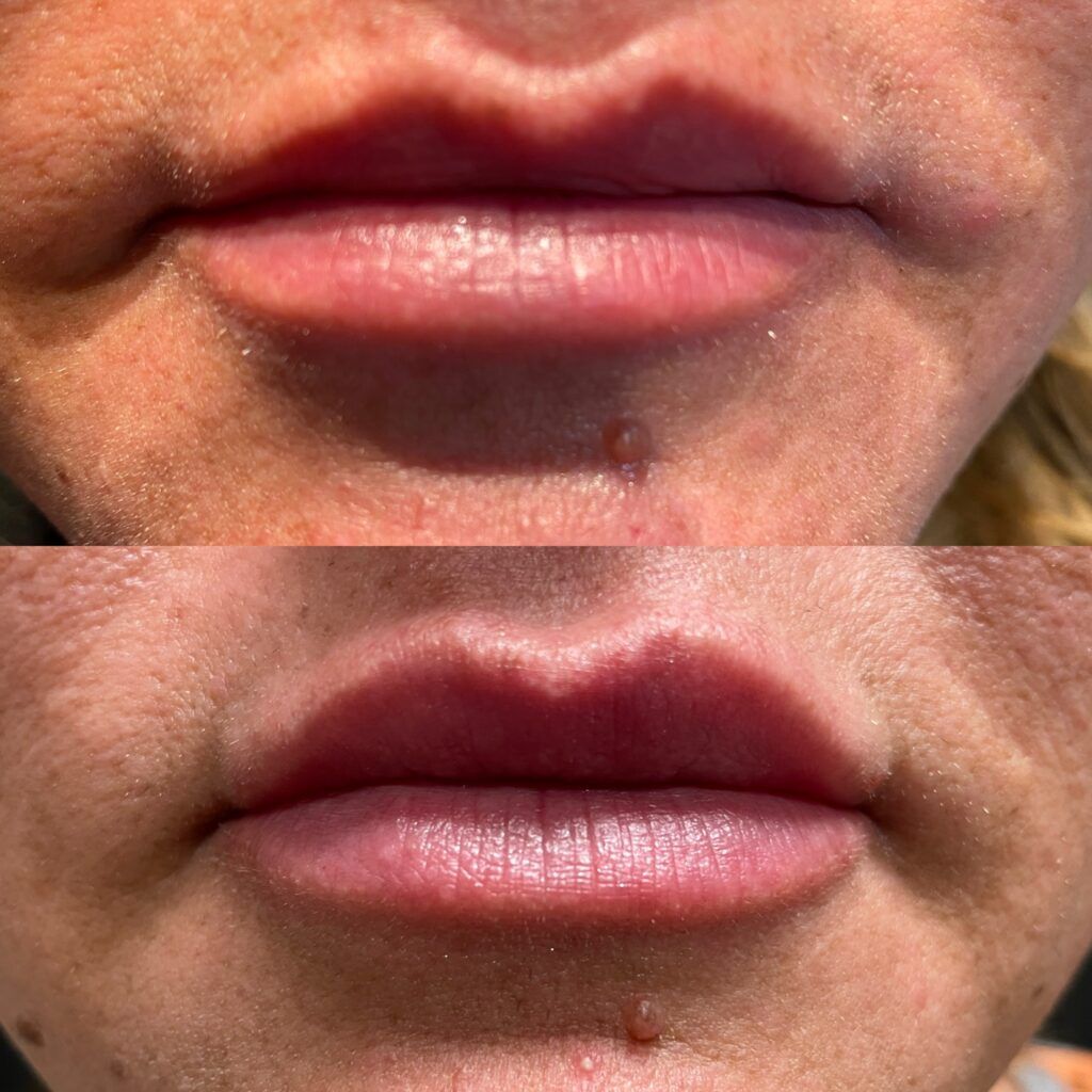 a before and after photo of a woman 's lips .