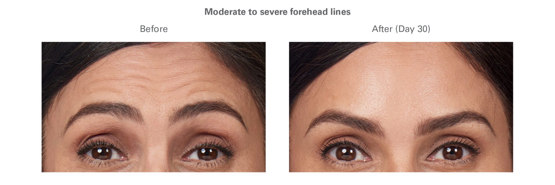 a before and after picture of a woman 's forehead .