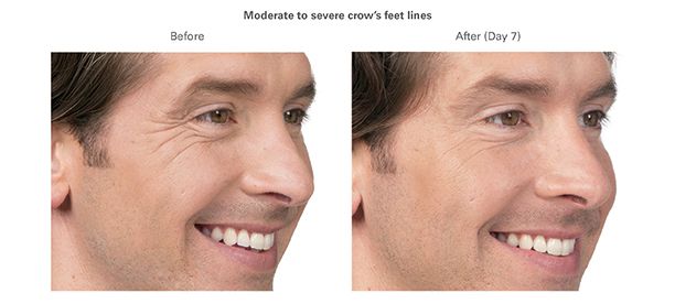 a before and after picture of a man 's face with wrinkles .