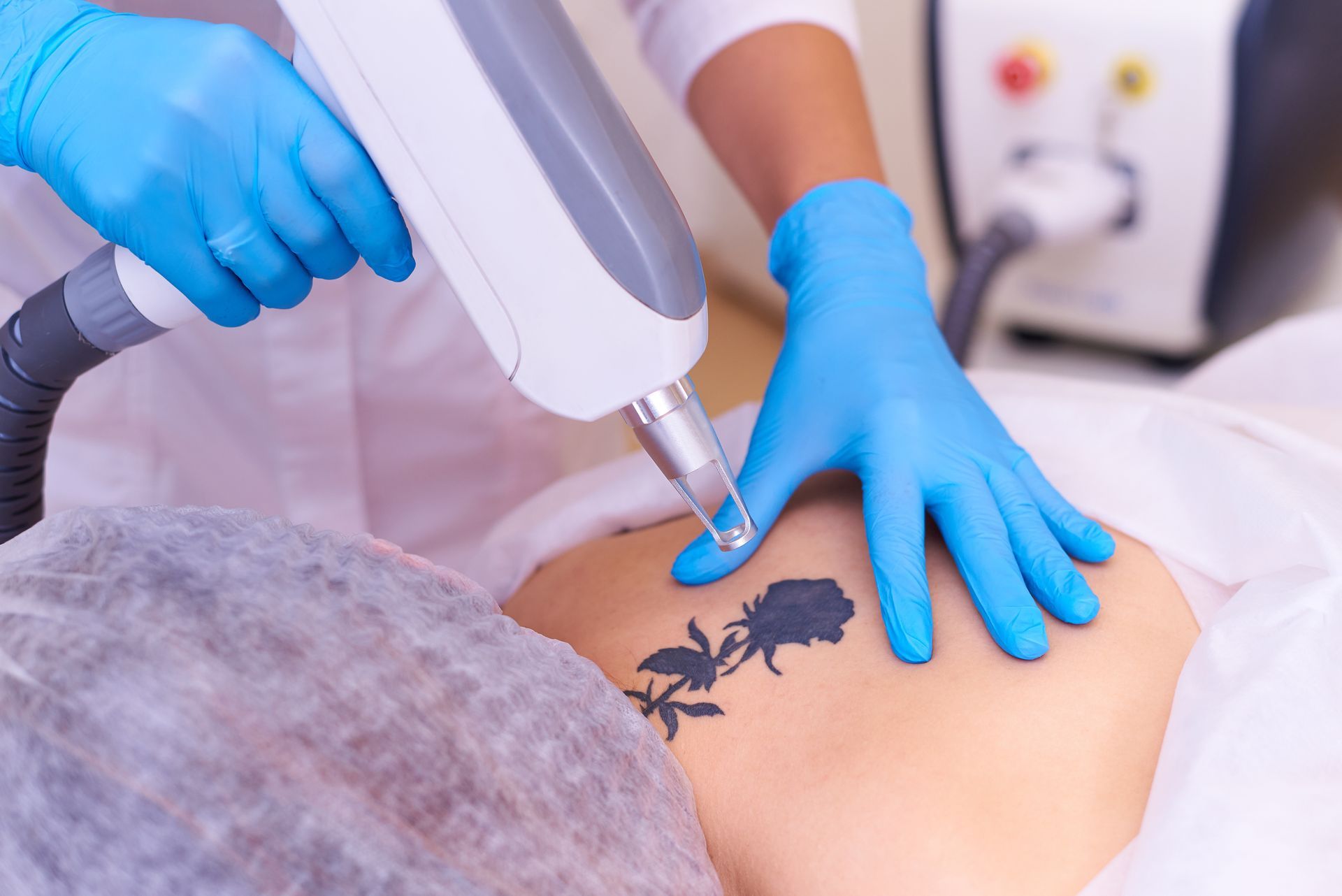 Blue-gloved technician using a laser device on a person’s tattooed lower back