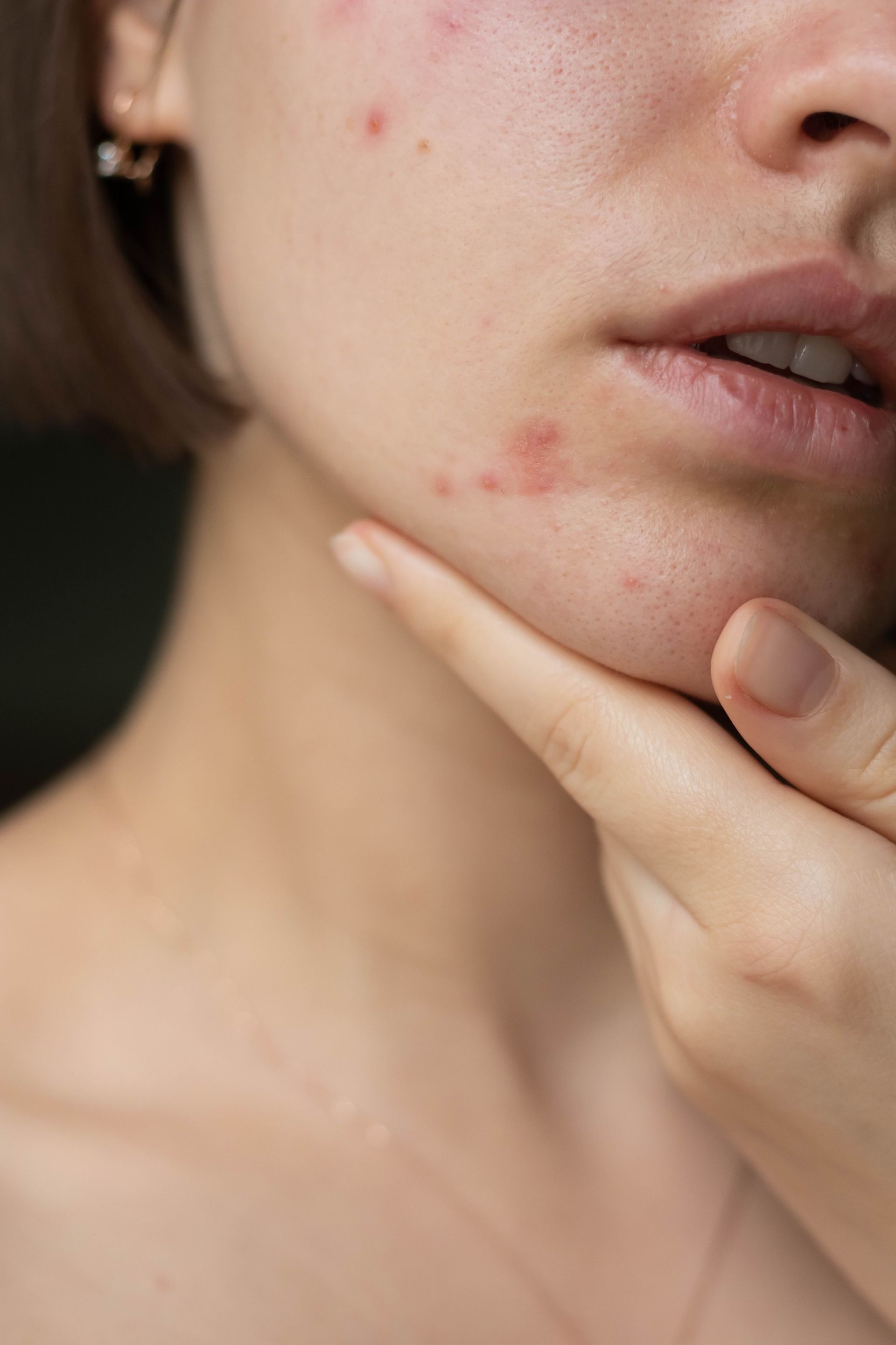a woman with acne on her face is touching her chin with her hand .