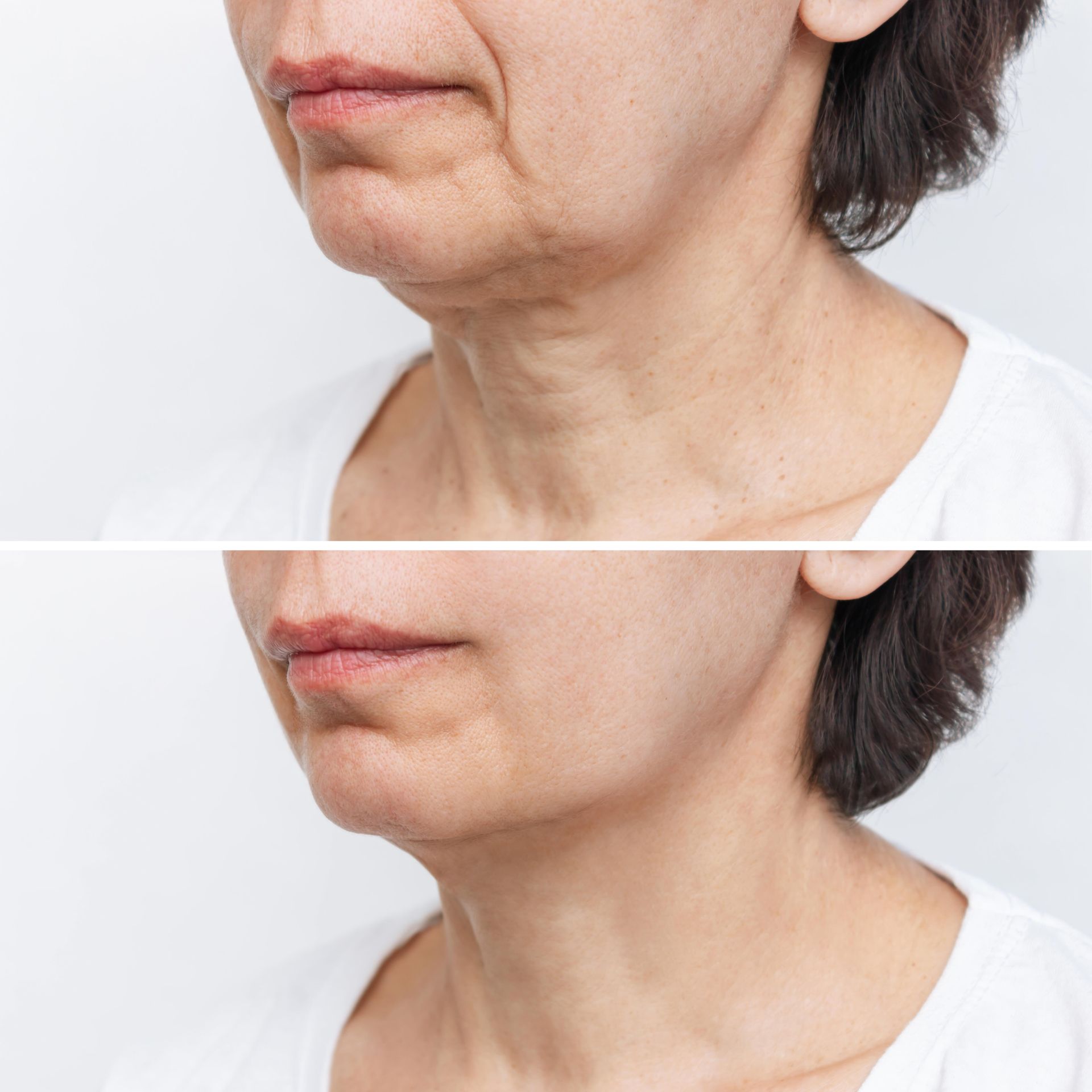 a before and after photo of a woman 's neck and chin .