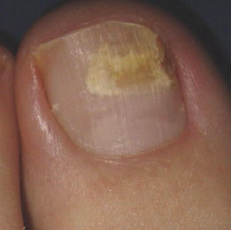 A close up of a person 's toenail with a yellow spot on it.