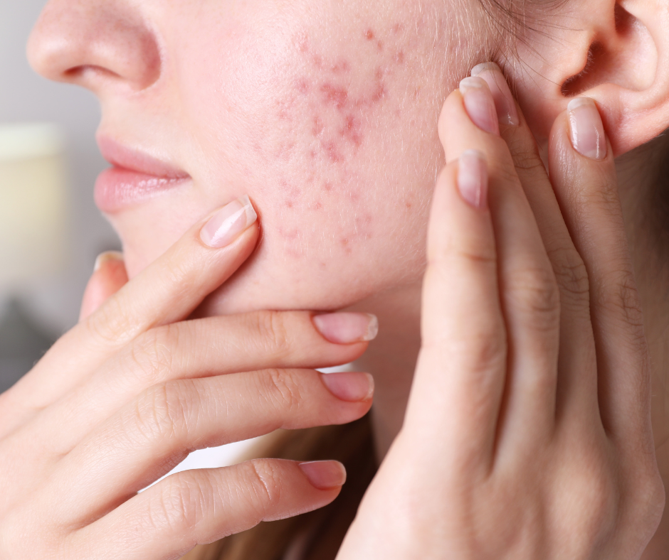 Close up of a woman with hands on her face with an allergy