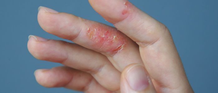 A human hand with dermatitis on two fingers