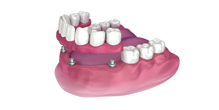 A computer generated image of a full denture with screws in it.