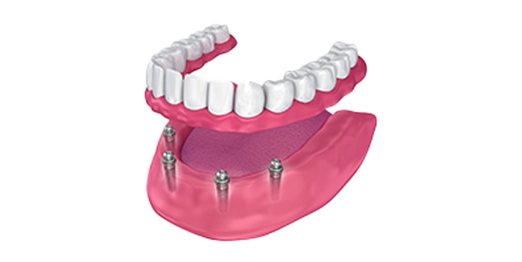 An illustration of a full denture with dental implants.