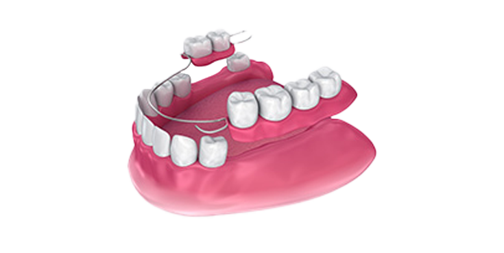 A close up of a denture with a brace on it.