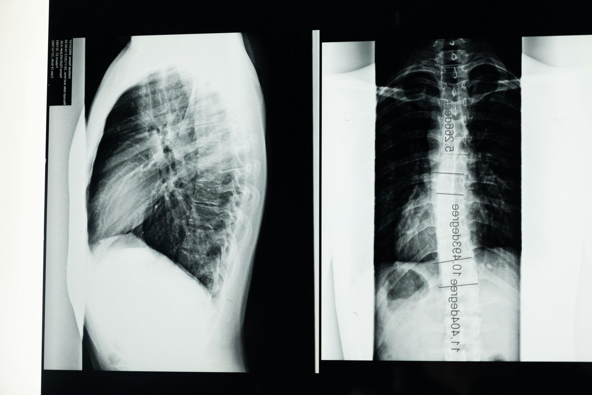 X-ray of a person's spine and chest, showing a side view and a front view, indicating potential medical evaluation.