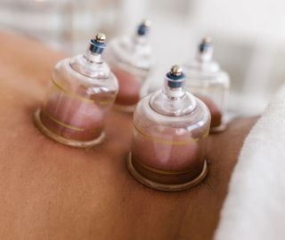 Vier cuppingtherapiecups worden met zuigkracht op de rug van de persoon geplaatst.
